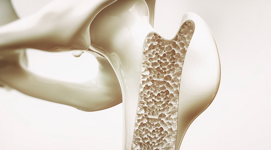 osteoporosi
